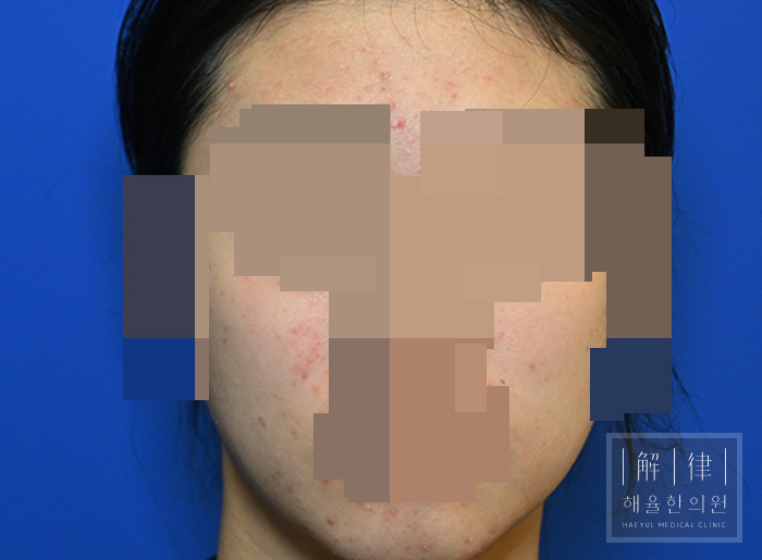 [목동점] 얼굴화농성여드름 치료 전 사진 - 해율한의원